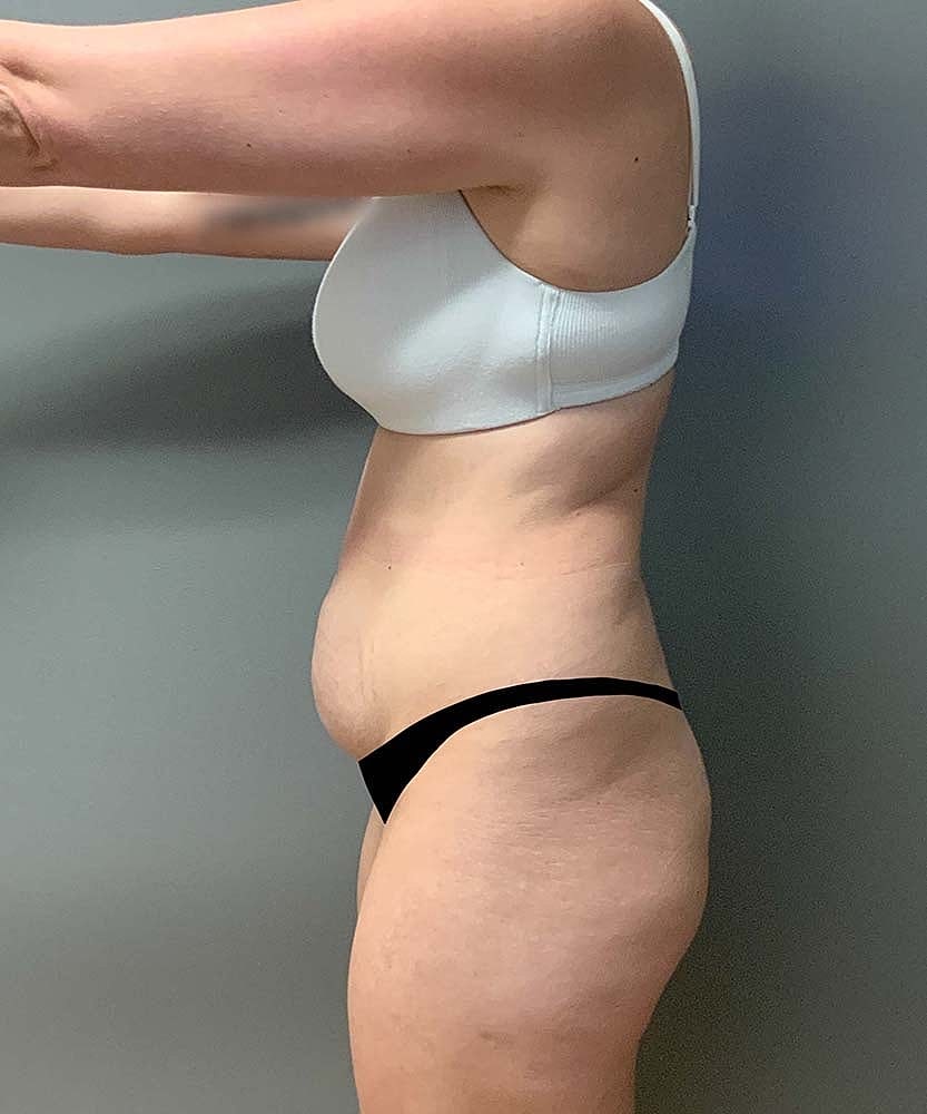 Tummy Tuck Before & After
