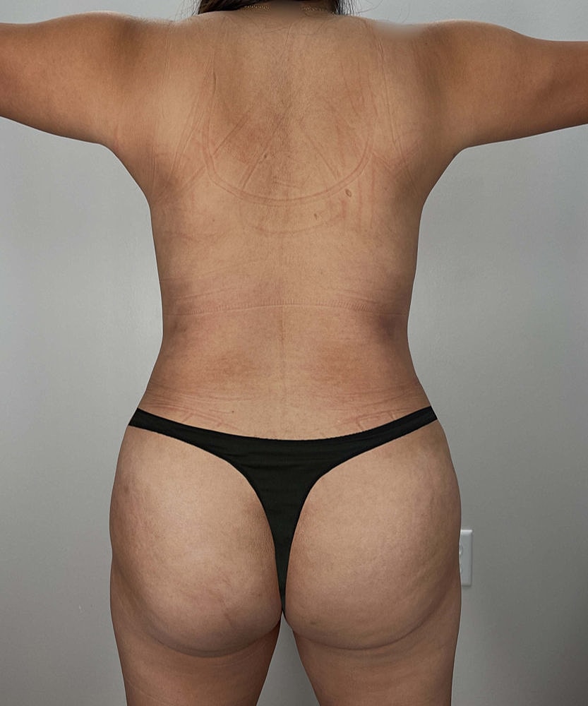 Tummy Tuck Before & After
