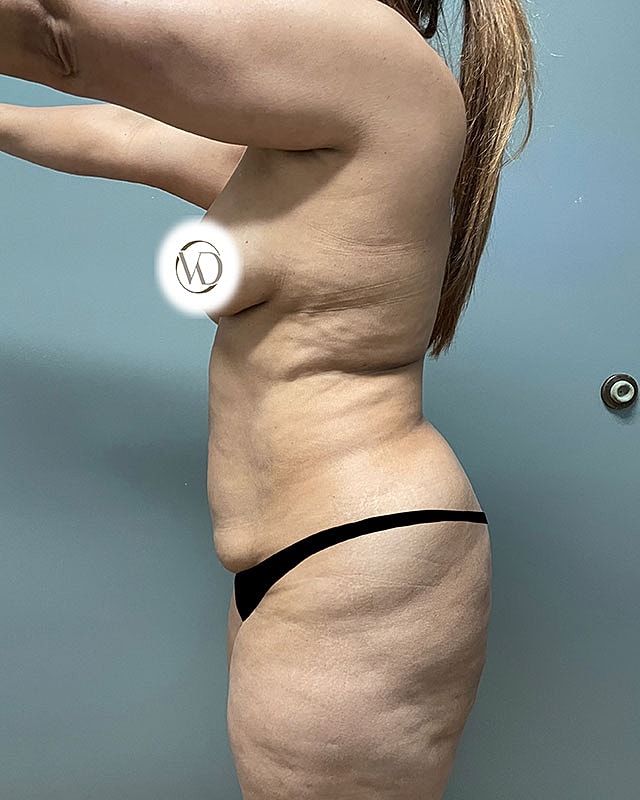 Tummy Tuck Before & After