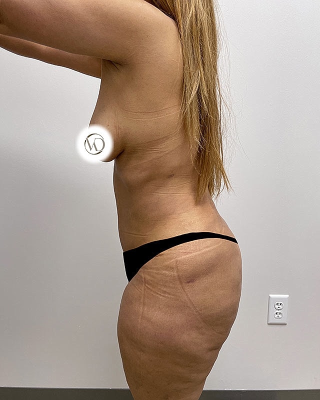 Tummy Tuck Before & After