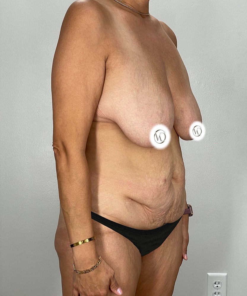 Tummy Tuck Before & After