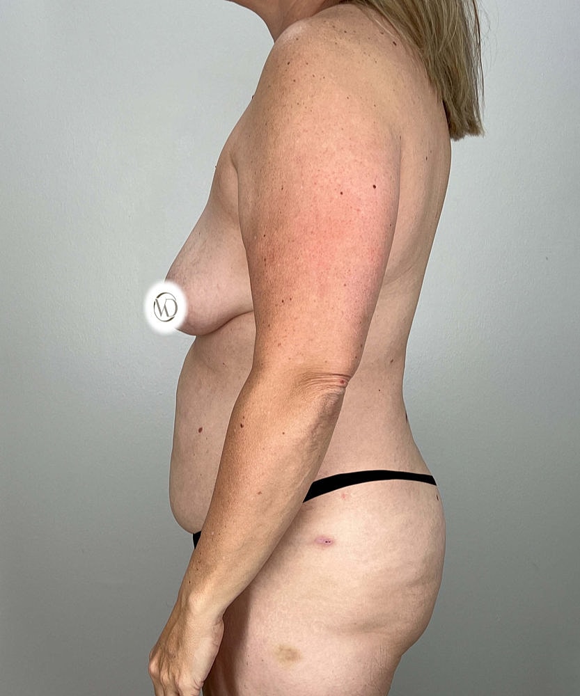 Tummy Tuck Before & After