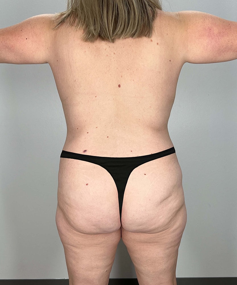Tummy Tuck Before & After