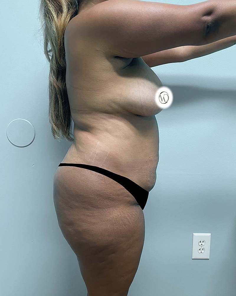 Tummy Tuck Before & After
