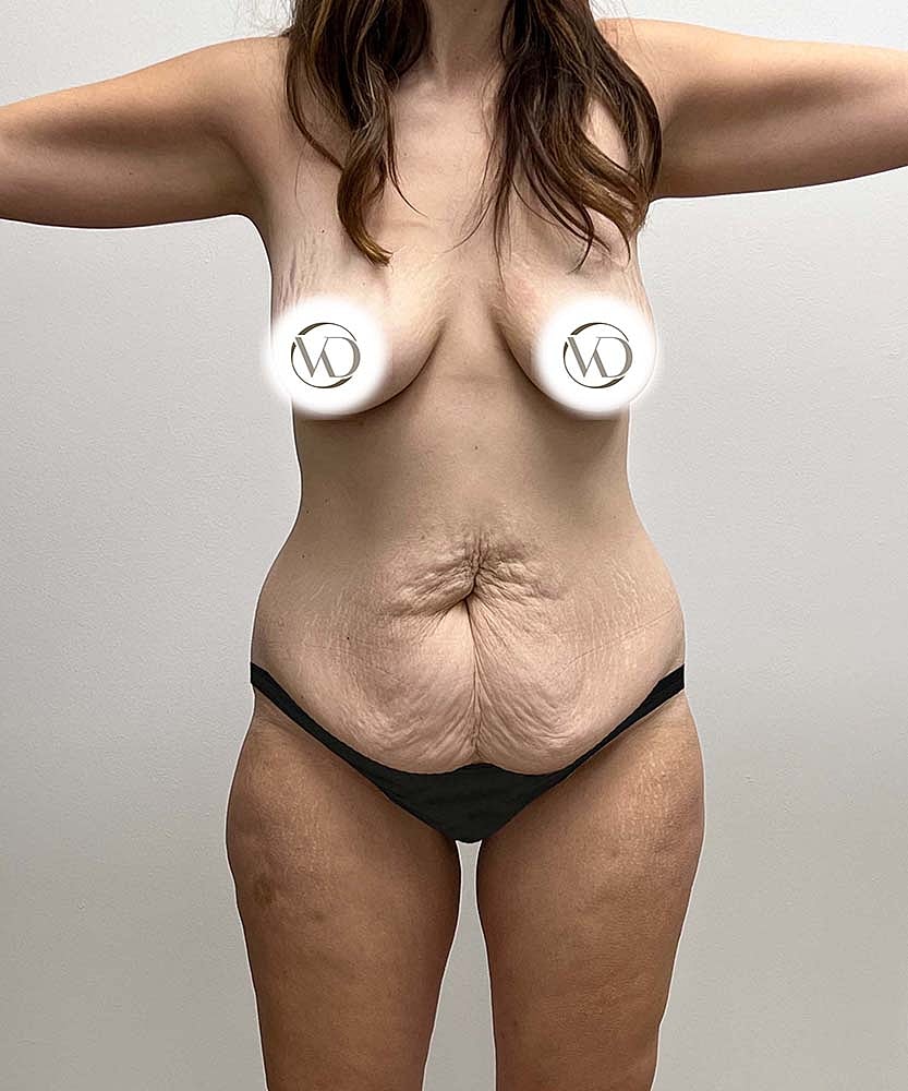 Tummy Tuck Before & After
