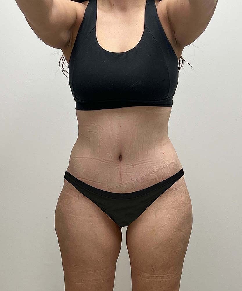 Tummy Tuck Before & After