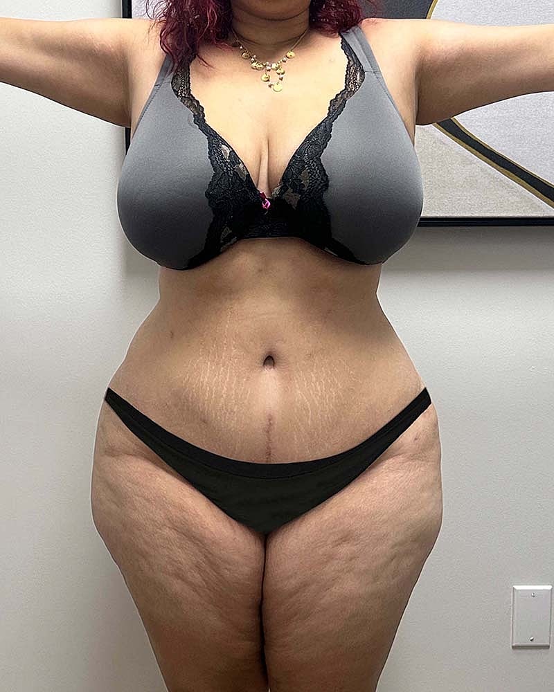 Tummy Tuck Before & After