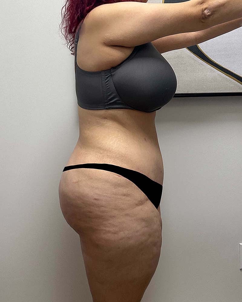 Tummy Tuck Before & After