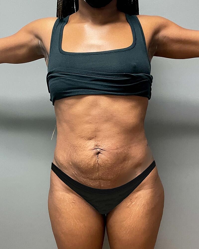 Tummy Tuck Before & After