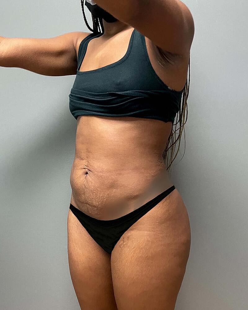 Tummy Tuck Before & After