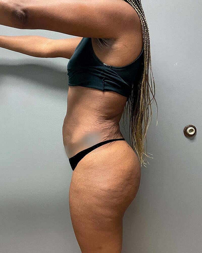 Tummy Tuck Before & After