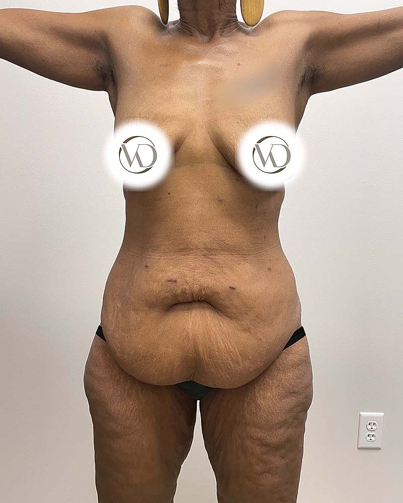 Tummy Tuck Before & After
