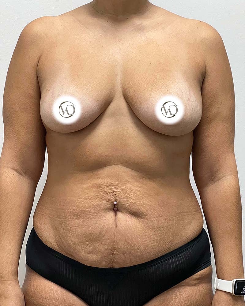 Tummy Tuck Before & After