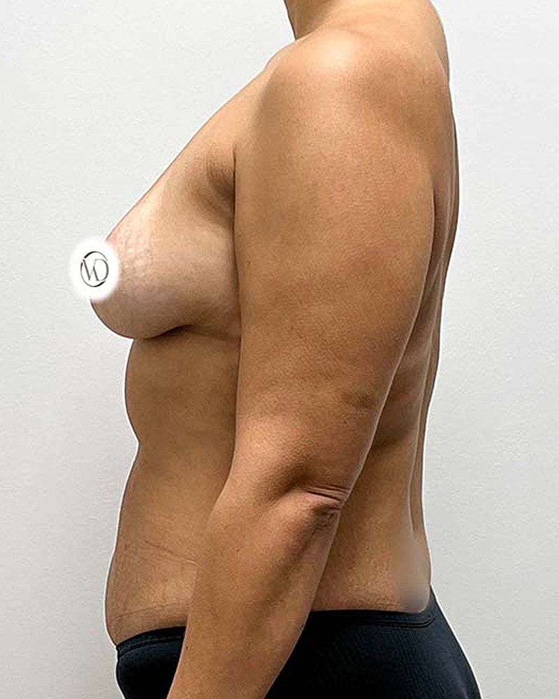 Tummy Tuck Before & After