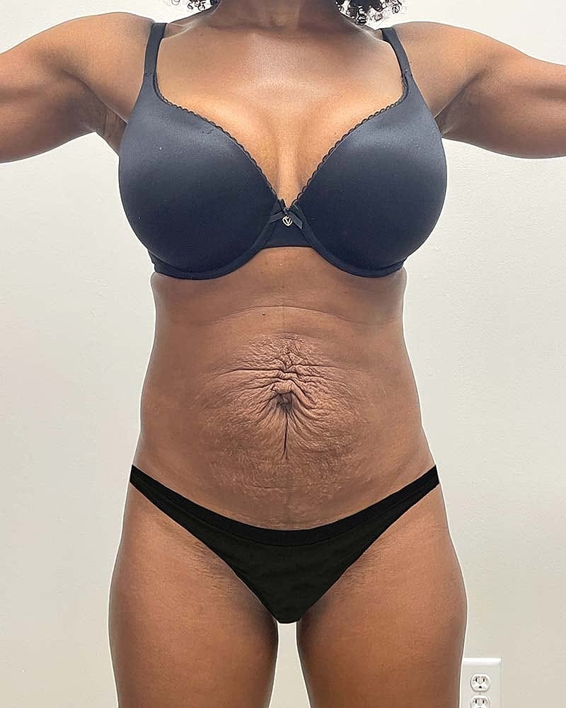 Tummy Tuck Before & After