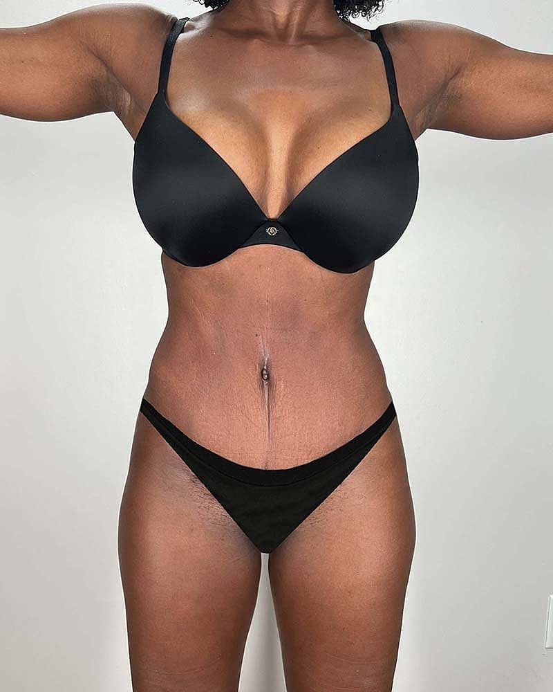 Tummy Tuck Before & After