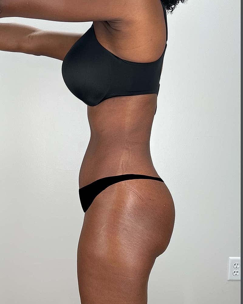 Tummy Tuck Before & After