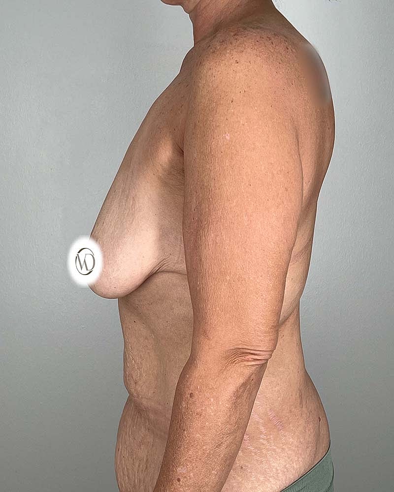 Tummy Tuck Before & After