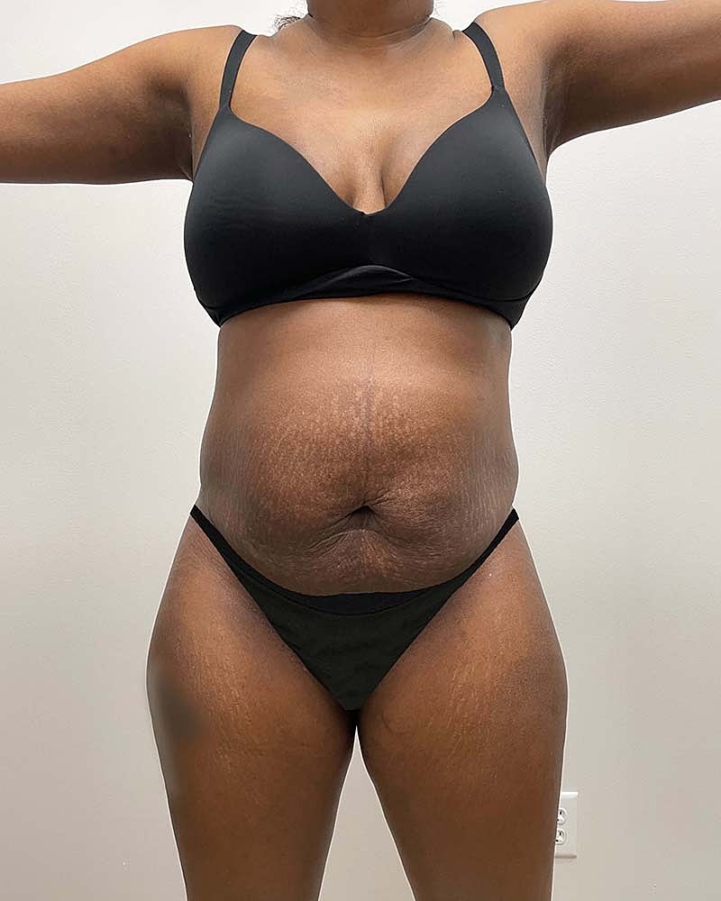 Tummy Tuck Before & After