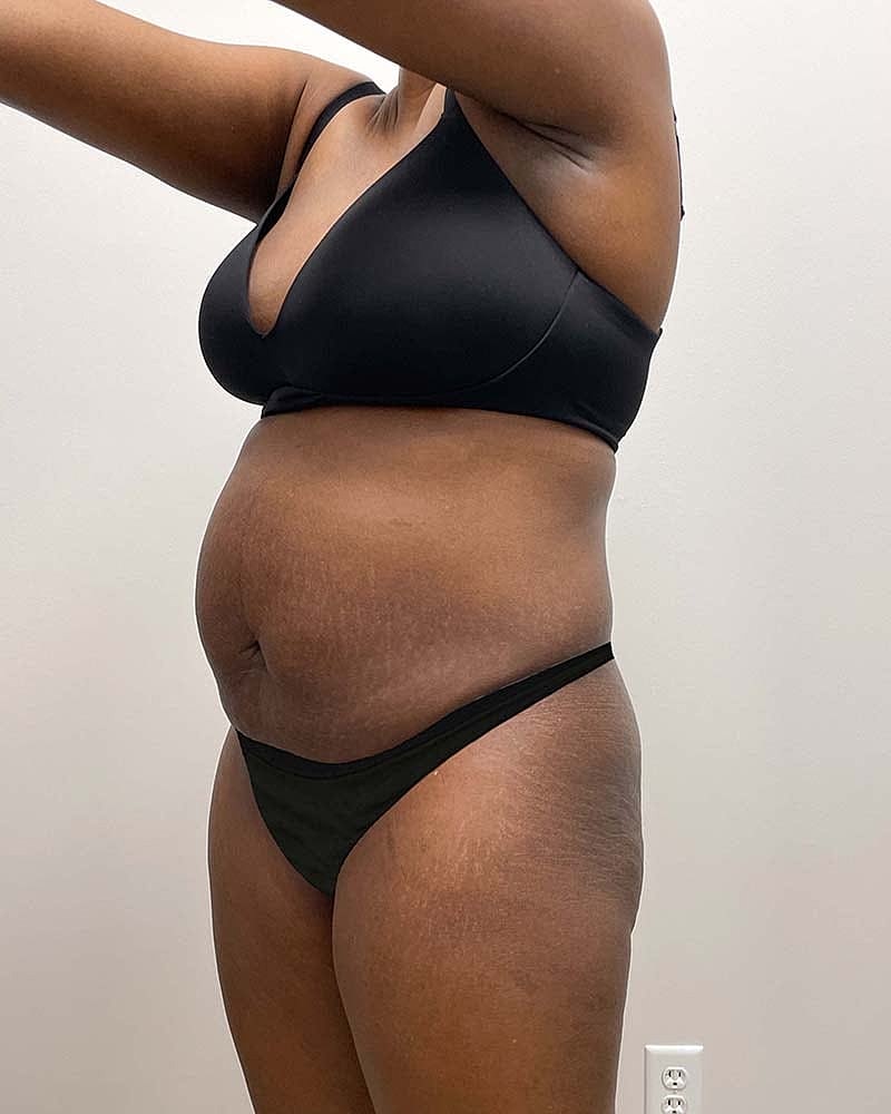 Tummy Tuck Before & After