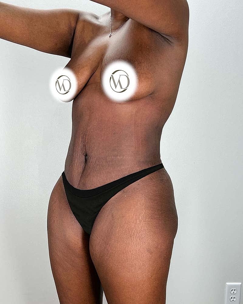 Tummy Tuck Before & After