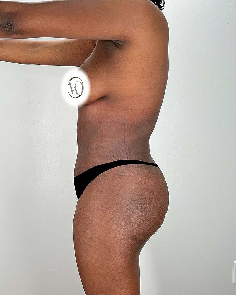Tummy Tuck Before & After