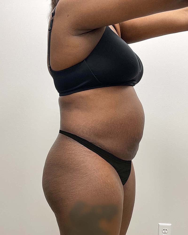Tummy Tuck Before & After