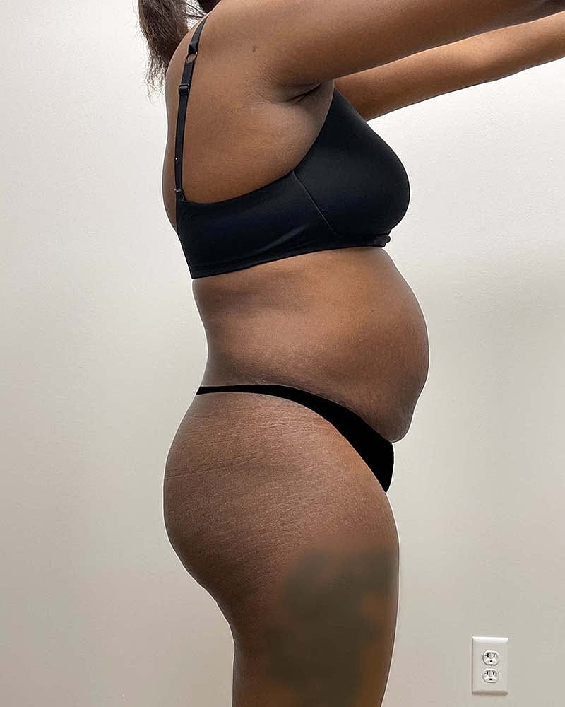 Tummy Tuck Before & After