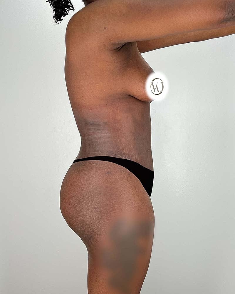 Tummy Tuck Before & After