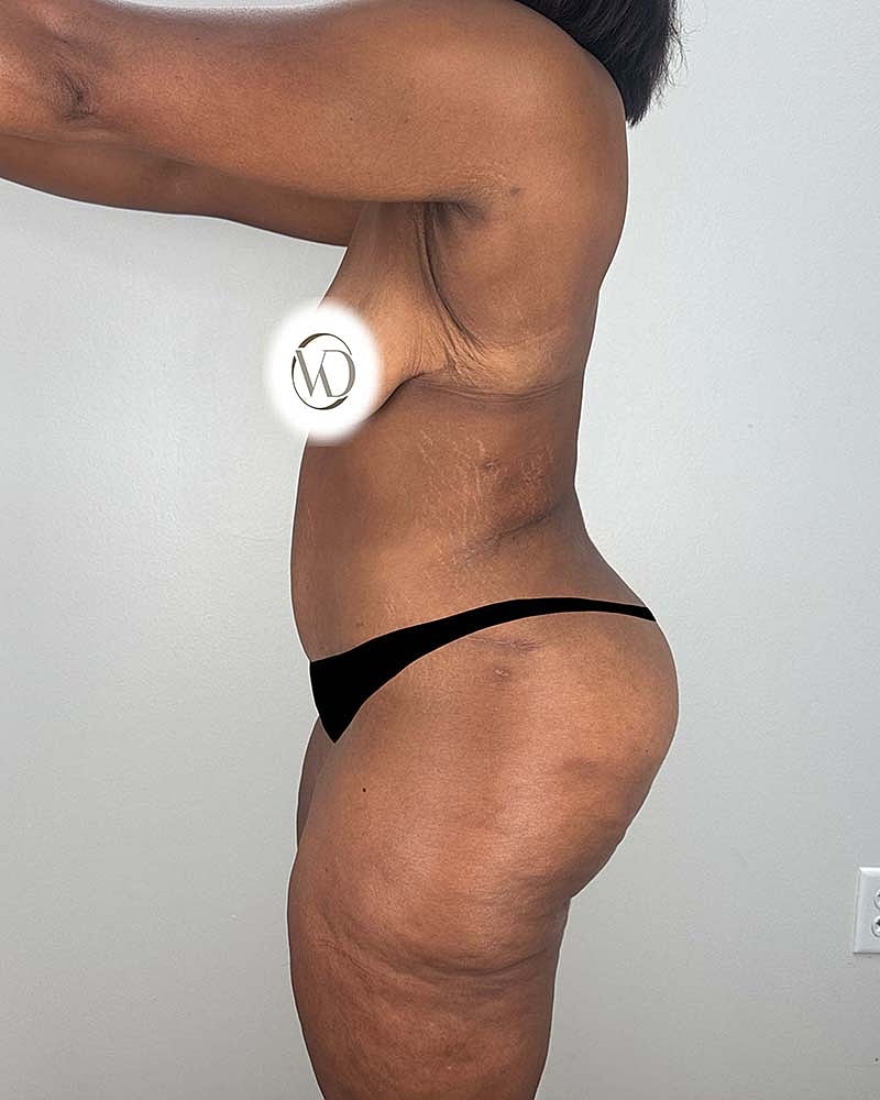 Tummy Tuck Before & After
