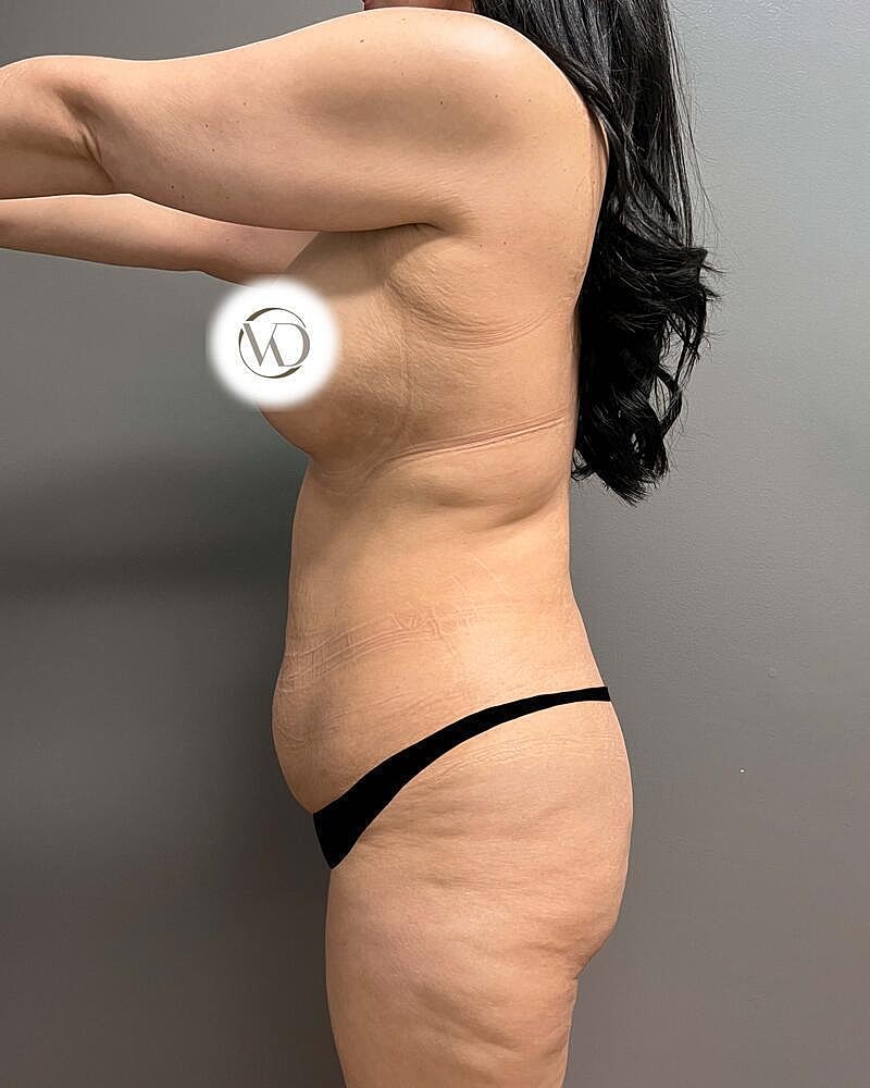 Tummy Tuck Before & After
