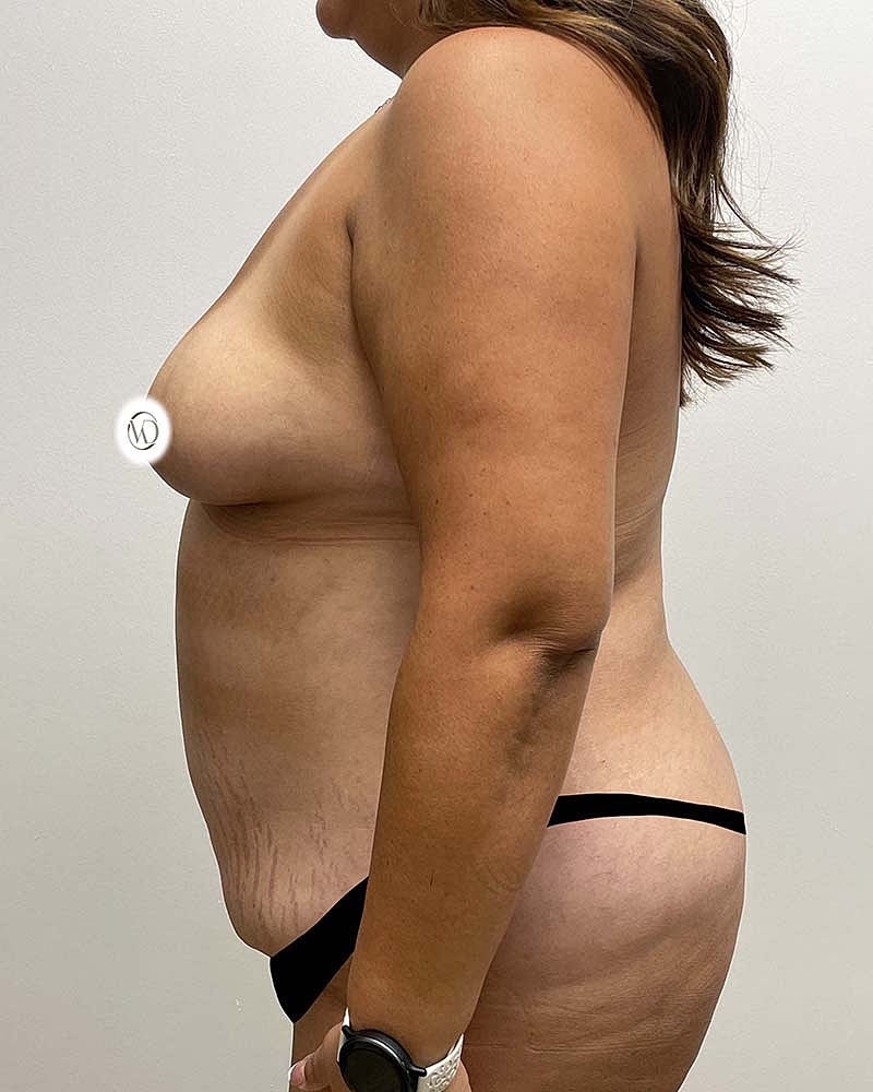 Tummy Tuck Before & After
