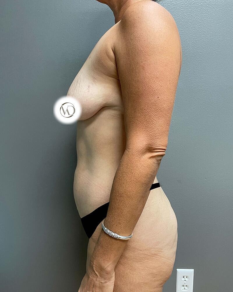 Tummy Tuck Before & After