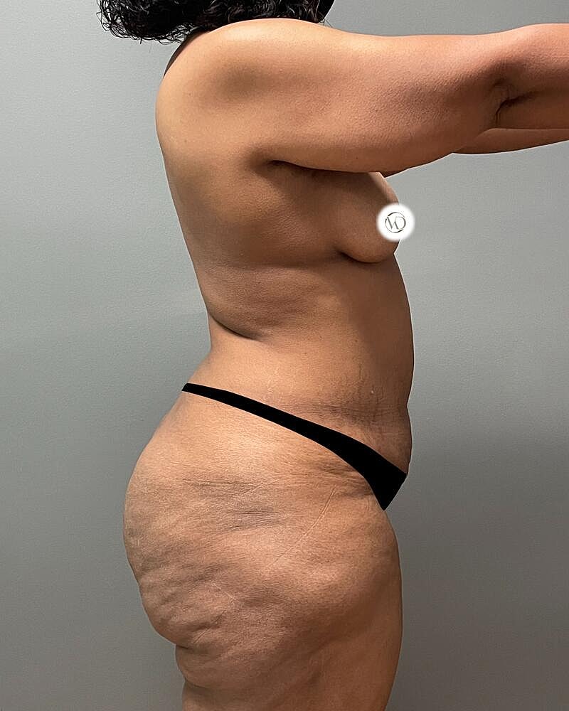 Tummy Tuck Before & After