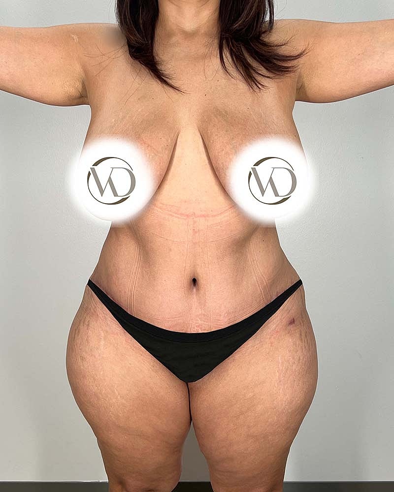 Tummy Tuck Before & After
