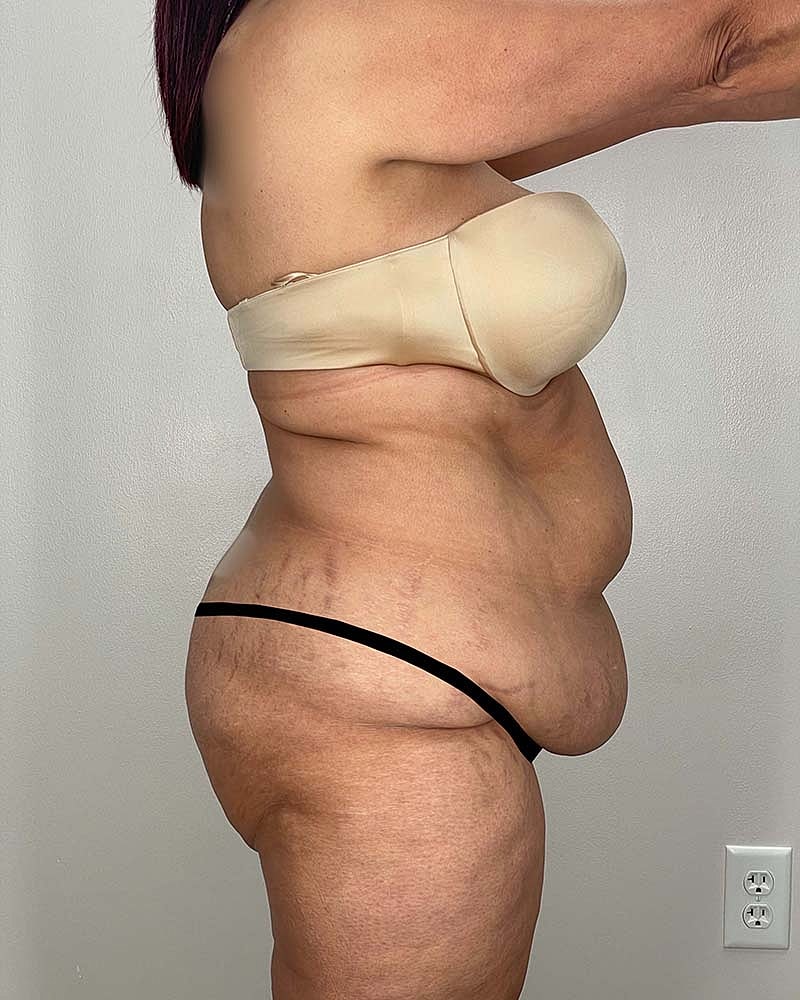 Tummy Tuck Before & After