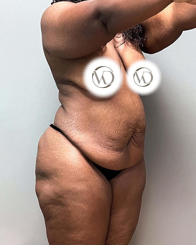 Tummy Tuck Before & After