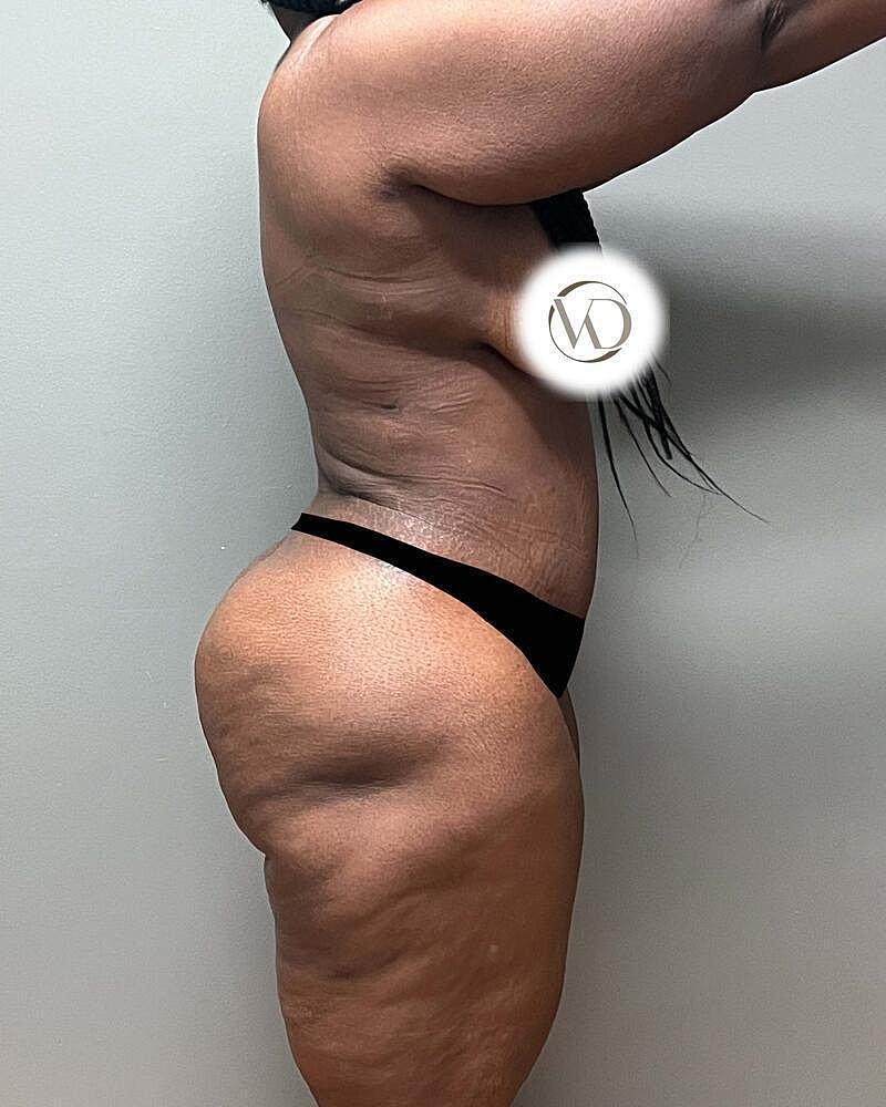 Tummy Tuck Before & After