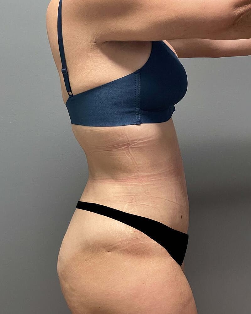 Tummy Tuck Before & After