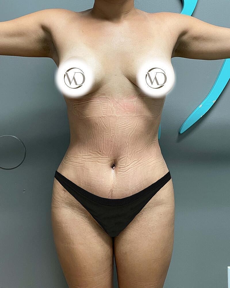 Tummy Tuck Before & After