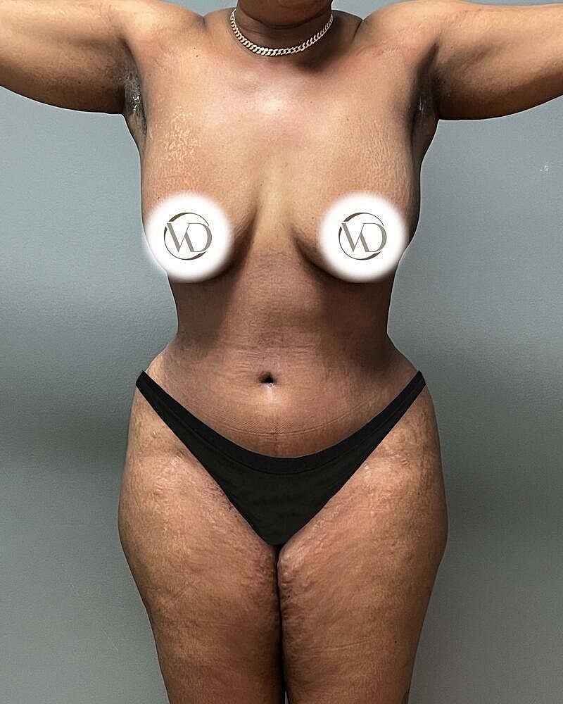 Tummy Tuck Before & After