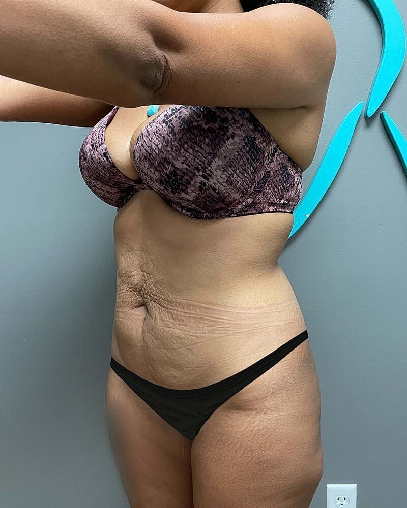 Tummy Tuck Before & After