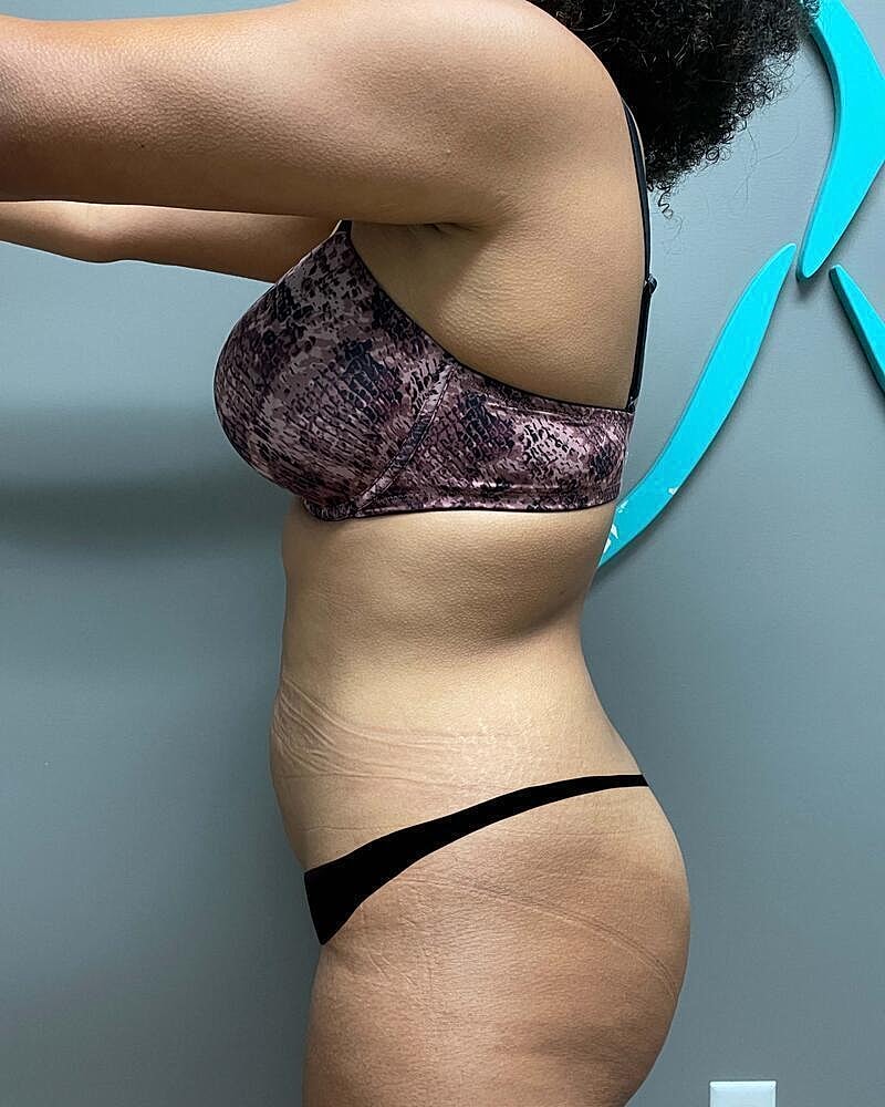 Tummy Tuck Before & After