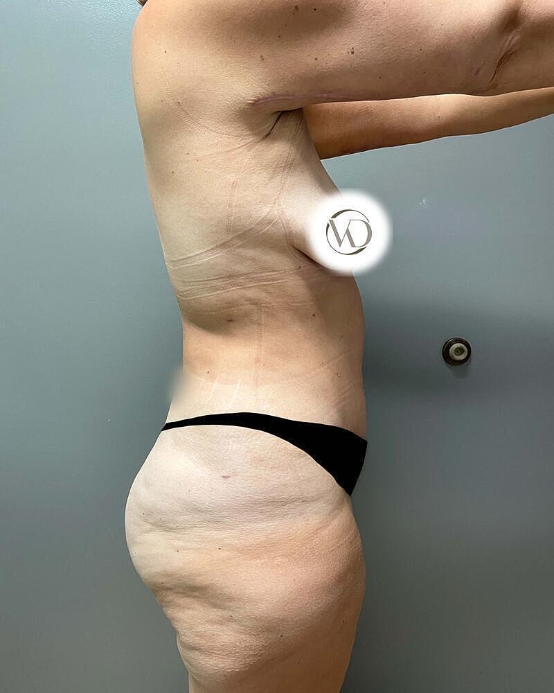 Tummy Tuck Before & After