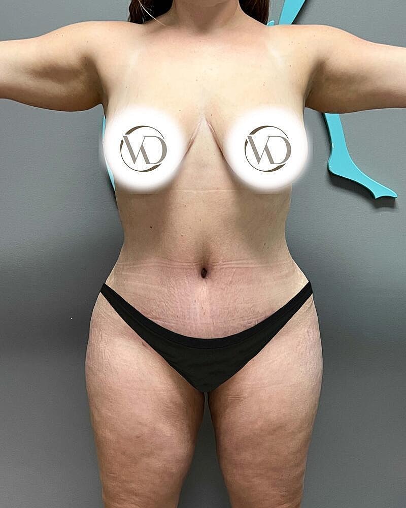 Tummy Tuck Before & After