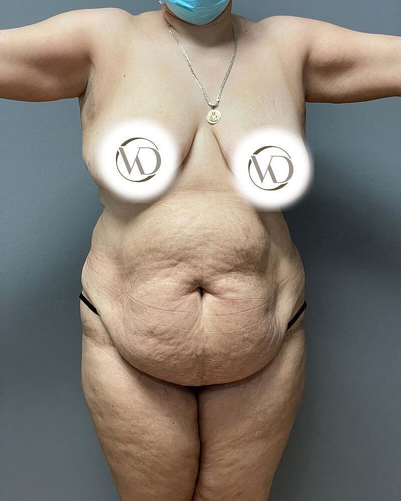 Tummy Tuck Before & After