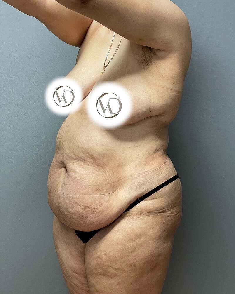 Tummy Tuck Before & After