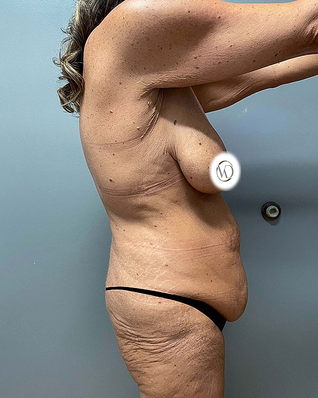 Tummy Tuck Before & After