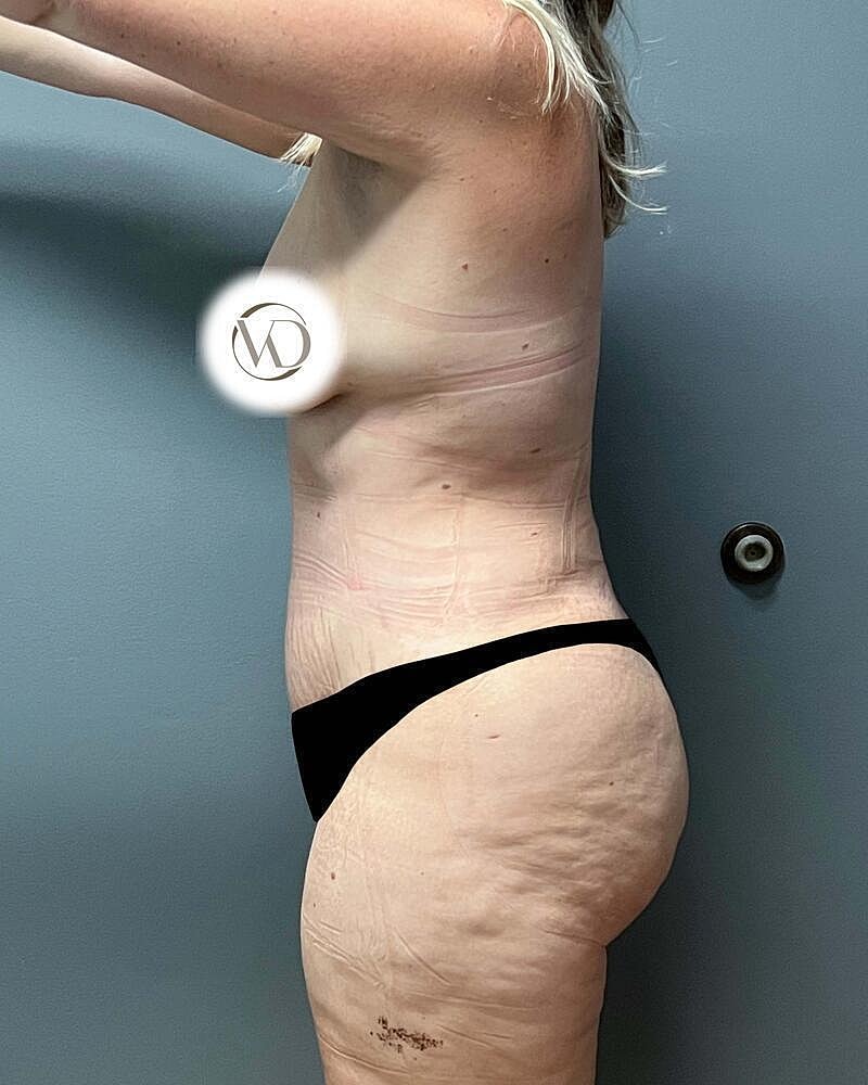 Tummy Tuck Before & After