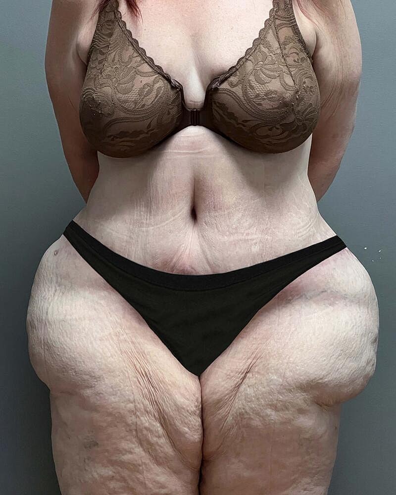 Tummy Tuck Before & After